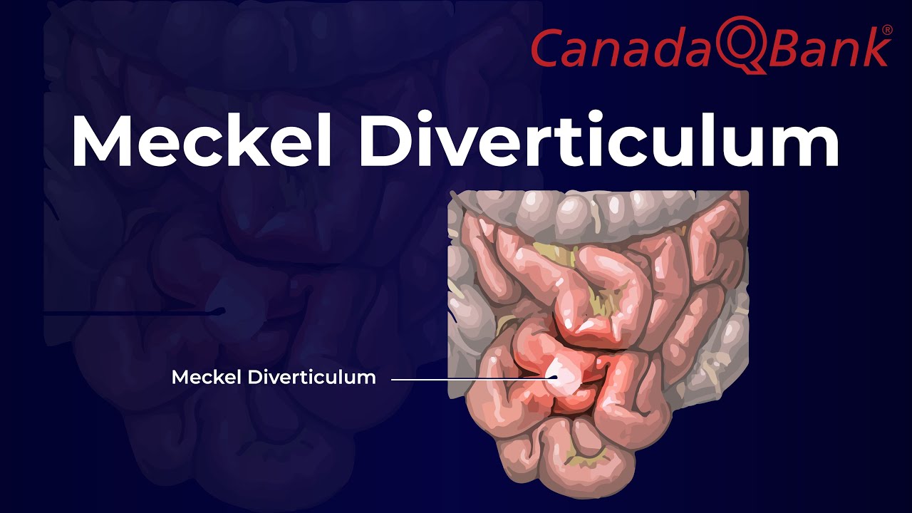 Дивертикул Меккеля: объяснение | Правило двух, диагностика и лечение | CanadaQBank