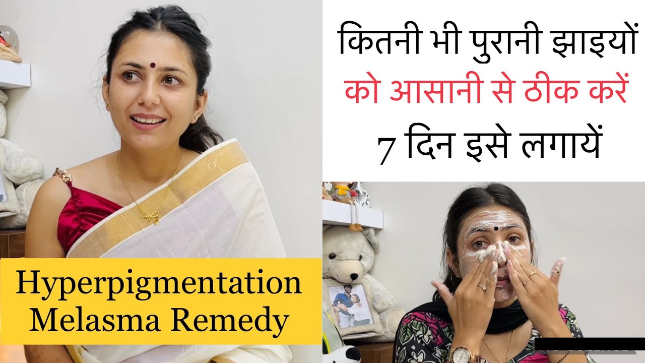 Hyperpigmentation Melasma Jhaiya Kaale Dhabbo ko 100% theek kare | Skin Remedies | Dr. Upasana Vohra