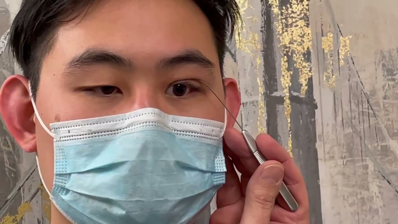 Double Eyelid Crease Formation Surgery