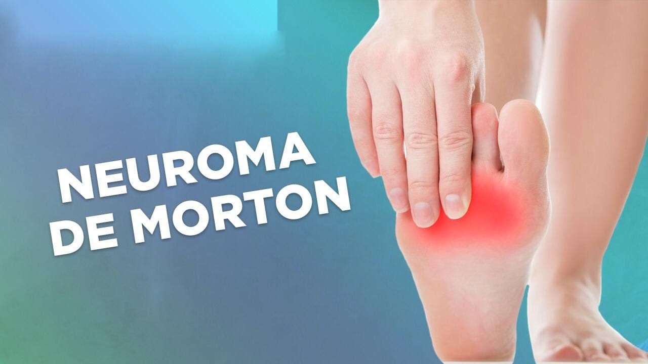Neuroma de Morton - 2 Formas de Aliviar (Erros no Final)