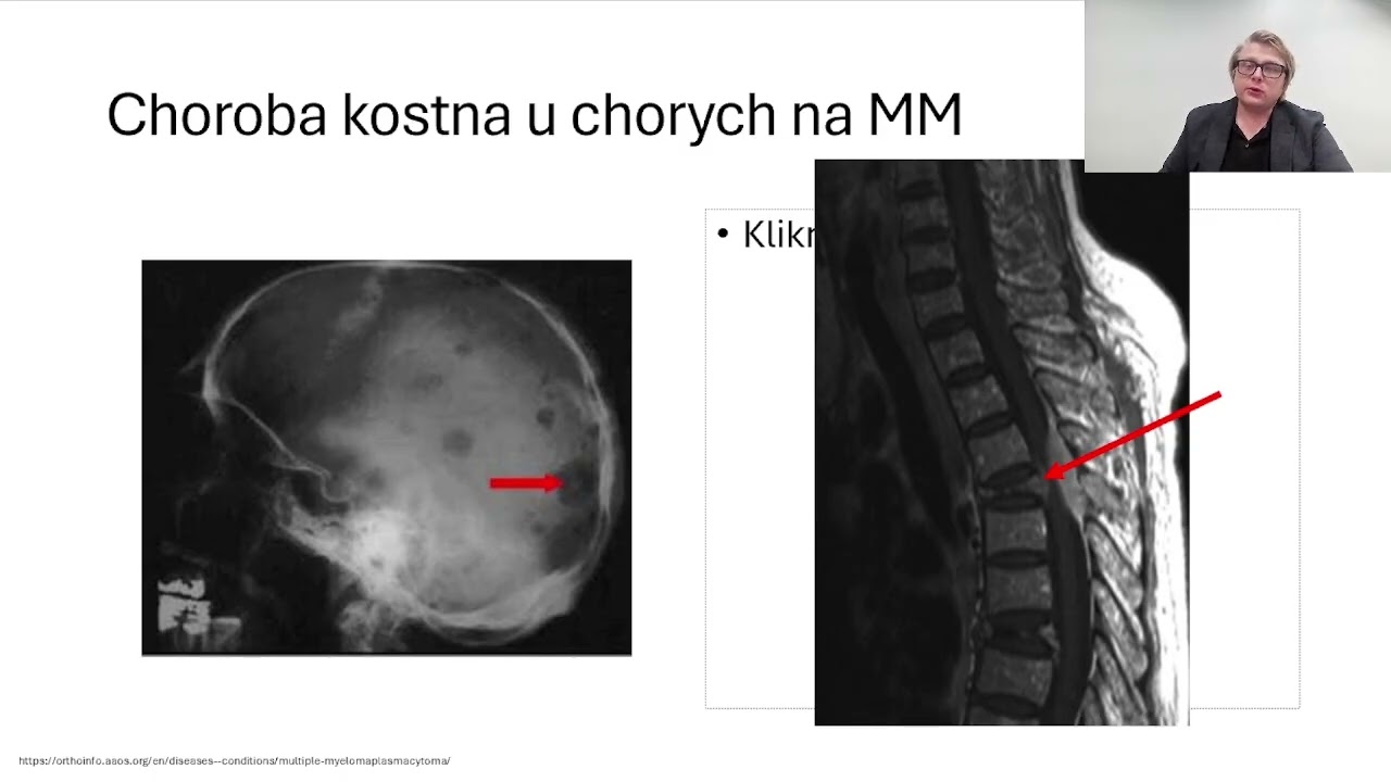 Szpiczak mnogi - objawy, leczenie, występowanie Dr n. med. Damian Mikulski III Warsztaty Edukacyjne