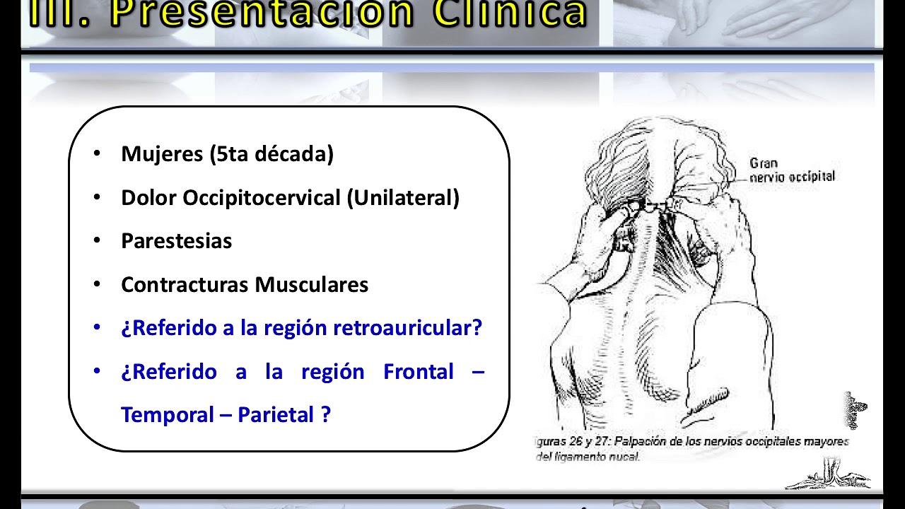 NEURALGIA OCCIPITAL