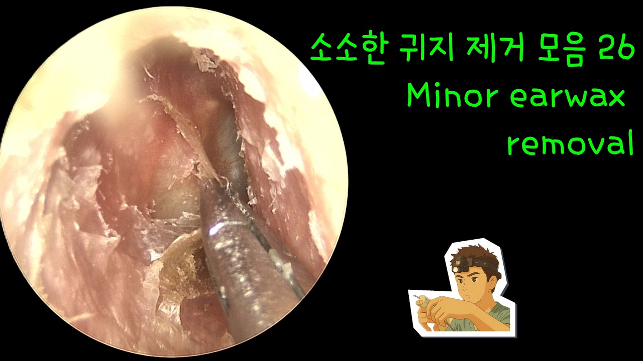 소소한 귀지 제거 모음 26 (Minor earwax removal)
