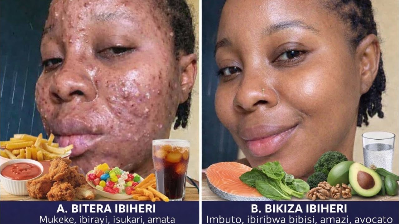 IBIRYO 5  Bitera ibiheri mu maso vis IBIRYO 5 BIGUKIZA IBIHERI MU MASO