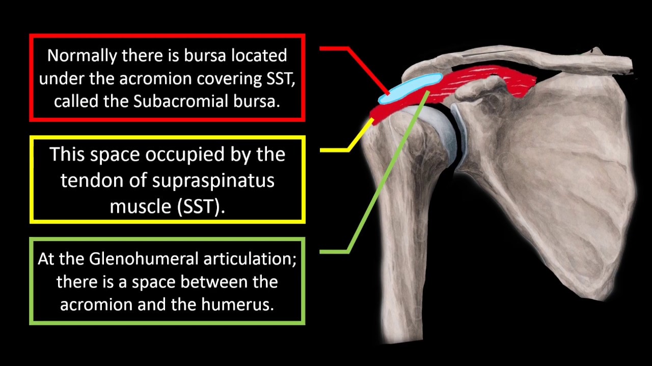 Subacromial bursitis.