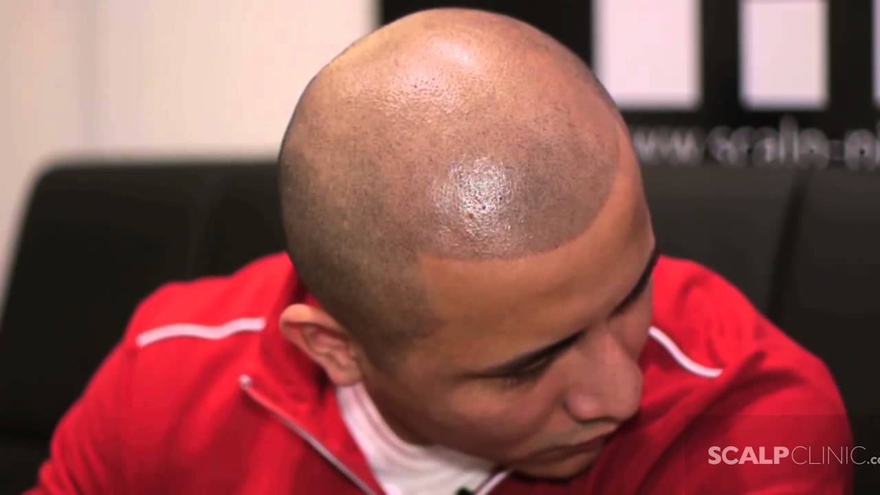 New York Scalp Micropigmentation - Scalp Clinic for Hair Loss