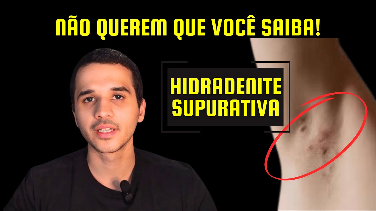 Hidradenite Supurativa: Sintomas, Tratamentos e Como Melhorar a Qualidade de Vida