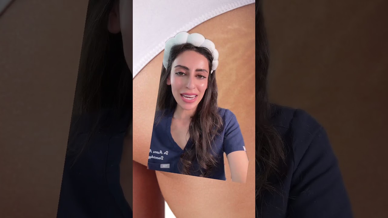 The RIGHT way to treat STRETCH MARKS. Part 2 | Dr Adel #shorts