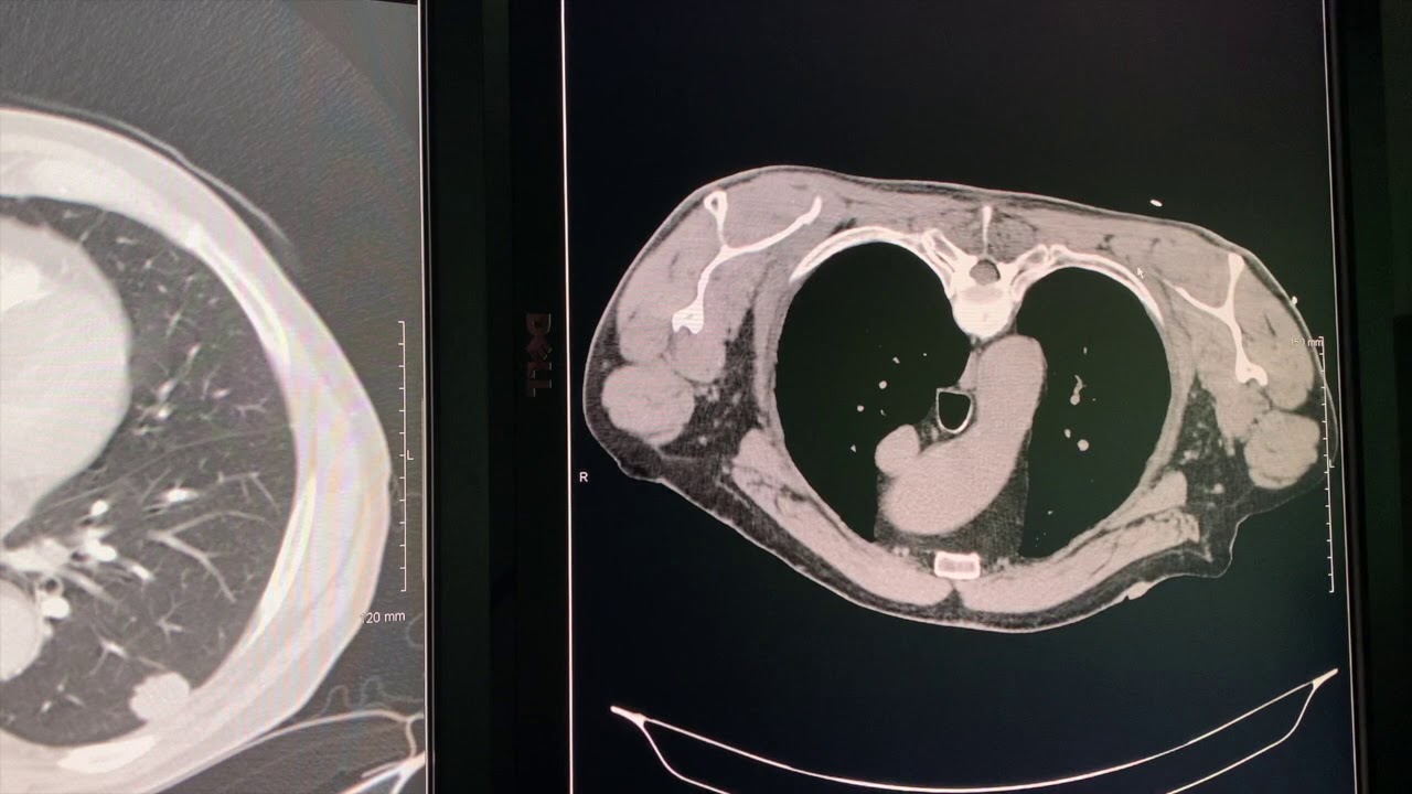 A Day in the Life of an Interventional Radiologist - Episode 3 (IR Cases)