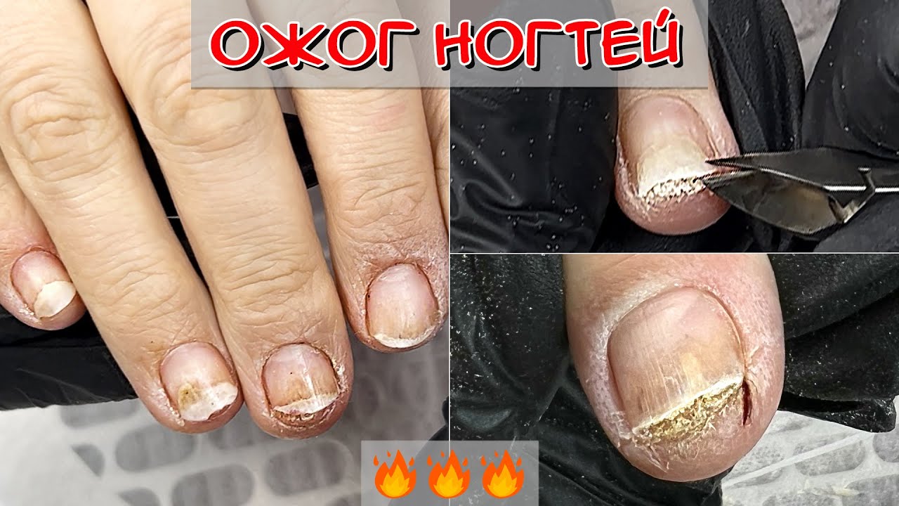 Ожог ногтей / Зачистка ногтя после ожога