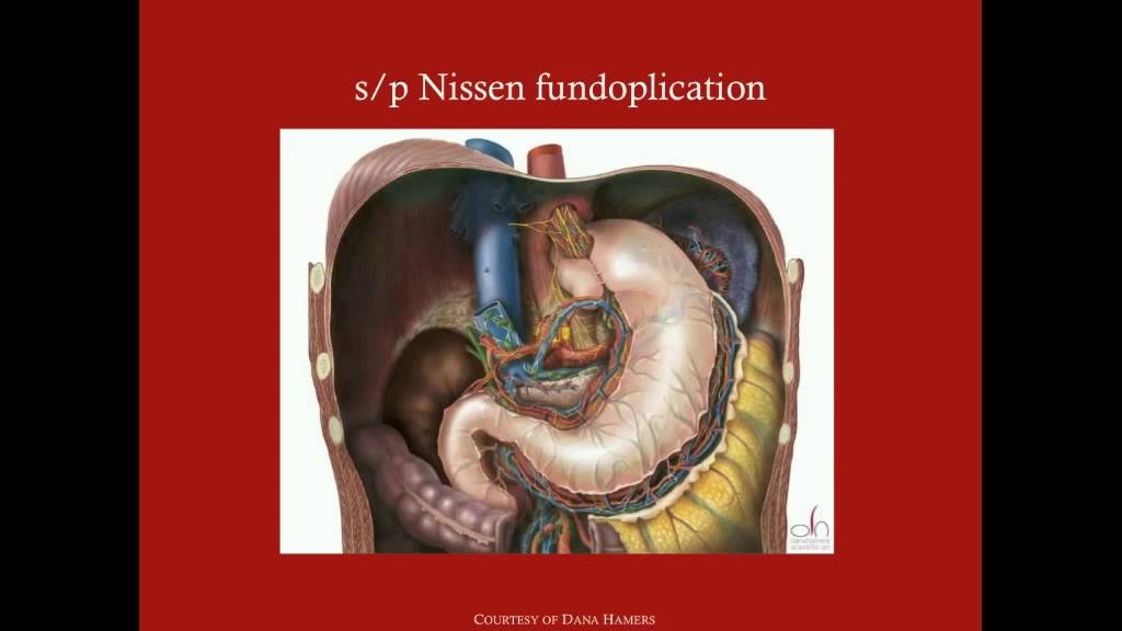 General Surgery Review Questions (Part 3) - CRASH! Medical Review Series