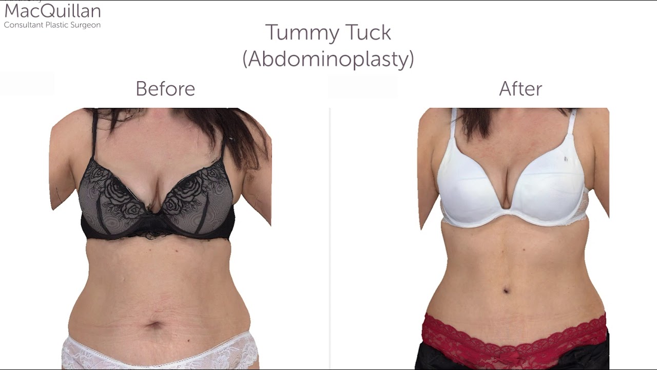 Tummy Tuck Surgery