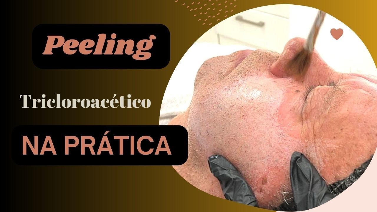 COMO É FEITO O PEELING DE ÁCIDO TRICLOROACÉTICO? | NA PRÁTICA| ÁCIDO ATA REJUVENESCEDOR. #peeling