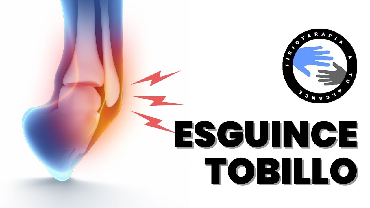 Esguince de tobillo, que es y que ocurre al torcernos un tobillo