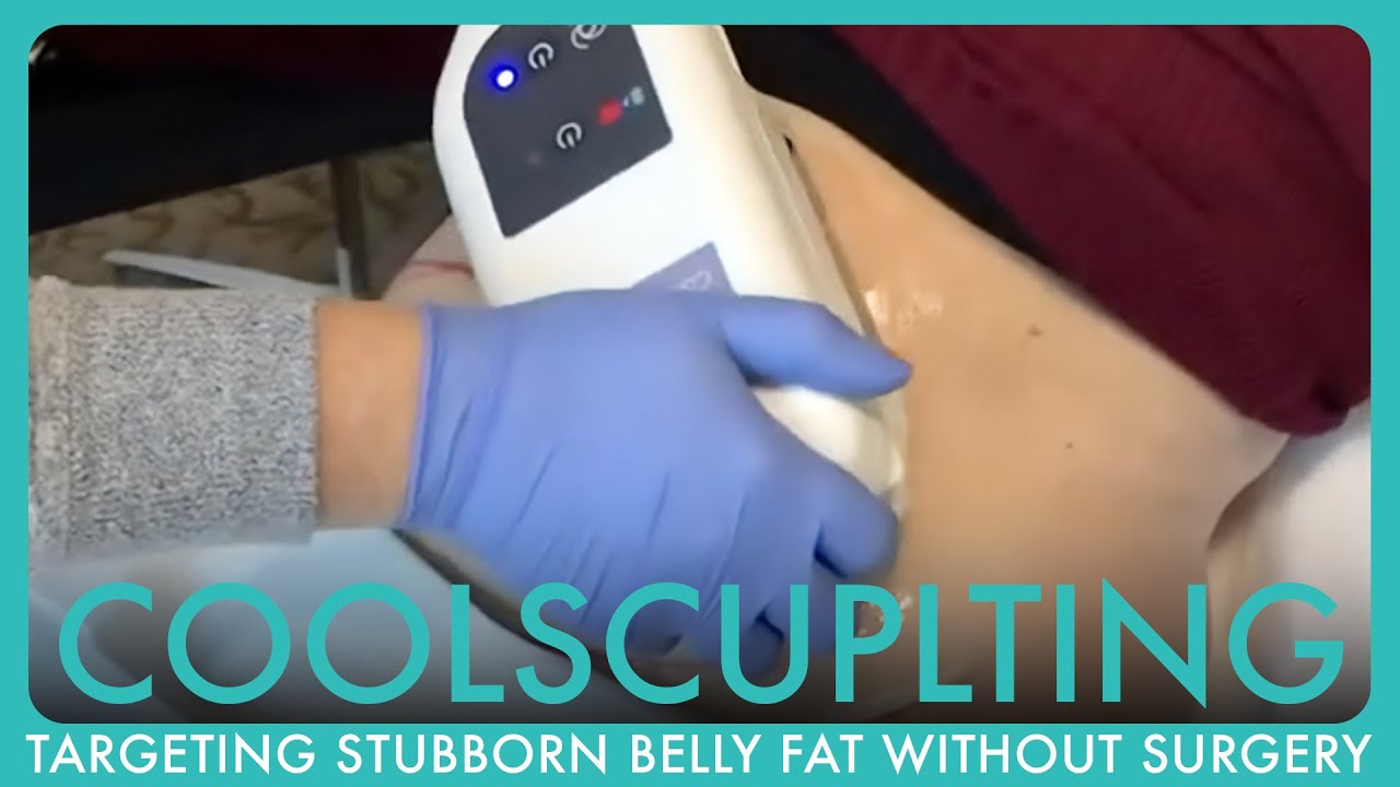 CoolSculpting the Abdomen: Targeting Stubborn Belly Fat Without Surgery