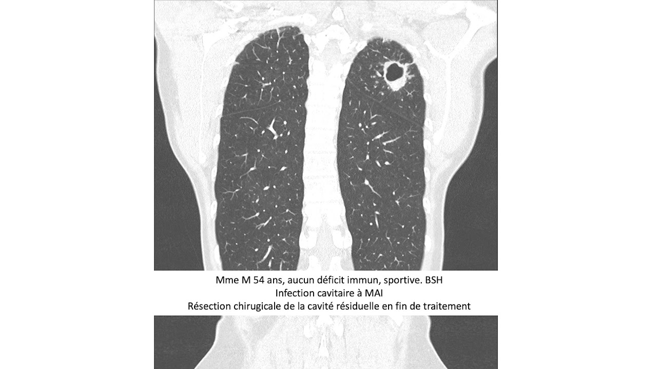 Mycobactéries non-tuberculeuses: rien à envier à la tuberculose - Pr J.-P. Janssens