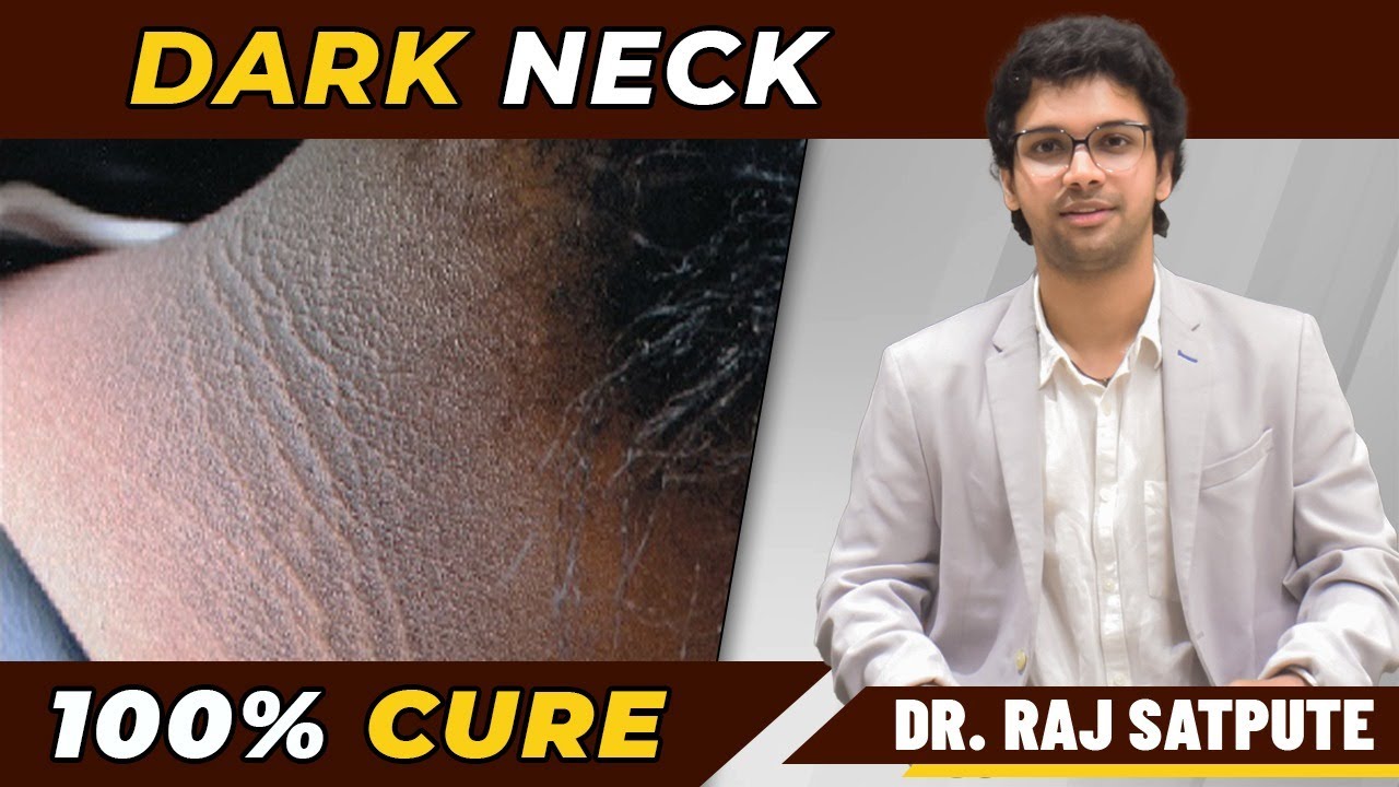 Neck Acanthosis Nigricans |  Dark Neck 100% Cure | Dr. Raj Satpute