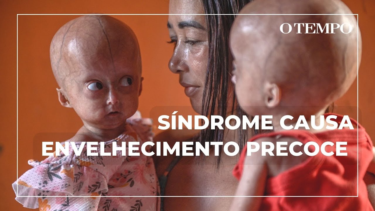 Síndrome da velhice precoce: conheça a história das gêmeas Elis e Eloá