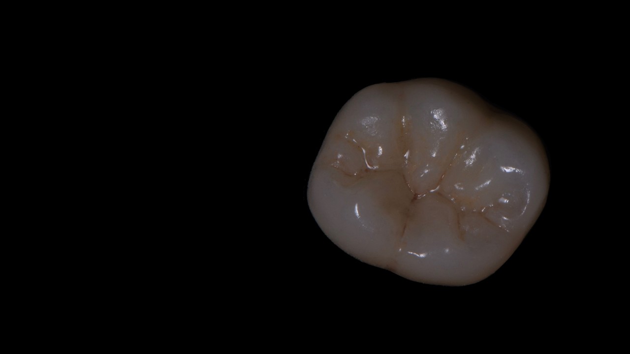 layering an emax posterior crown with ceramart