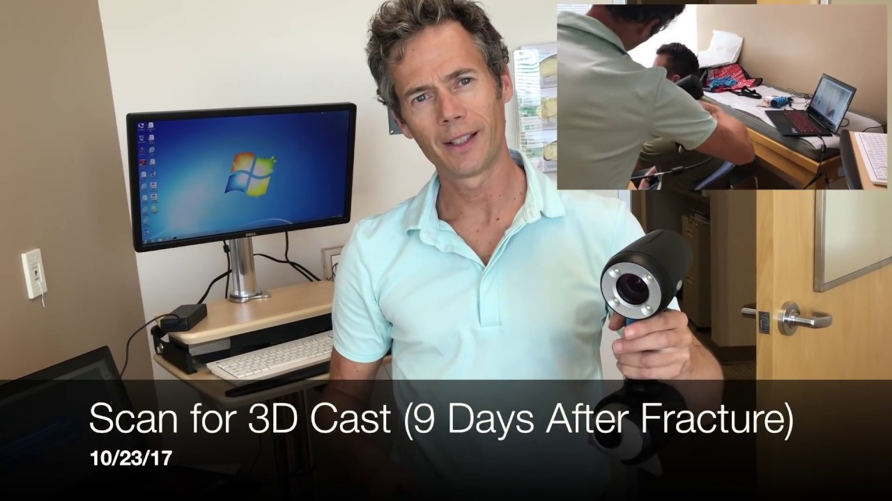 3D Printed Cast: Process and Review