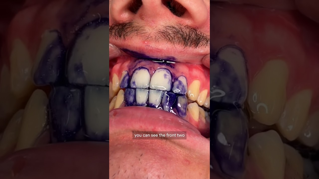 &ldquo;Era s&oacute; Passar Shampoo pra Clarear seus Dentes&rdquo;. Dentista Reage! #shorts