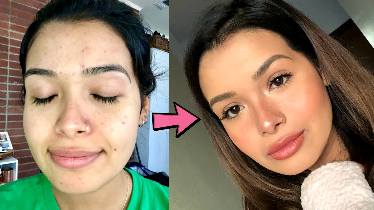 Acne Coverage Foundation Routine | ItsMandarin