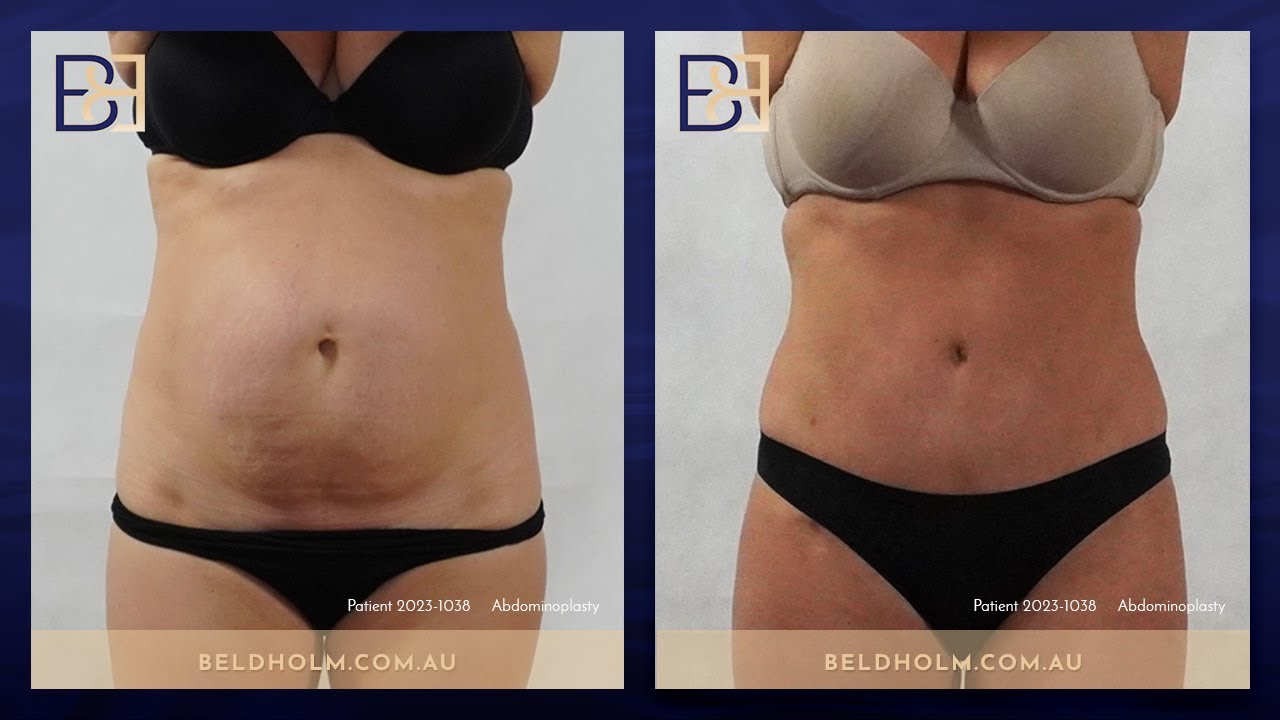 Abdominoplasty with VASER Liposuction and Diastasis Recti Repair (Patient 2023-1038)