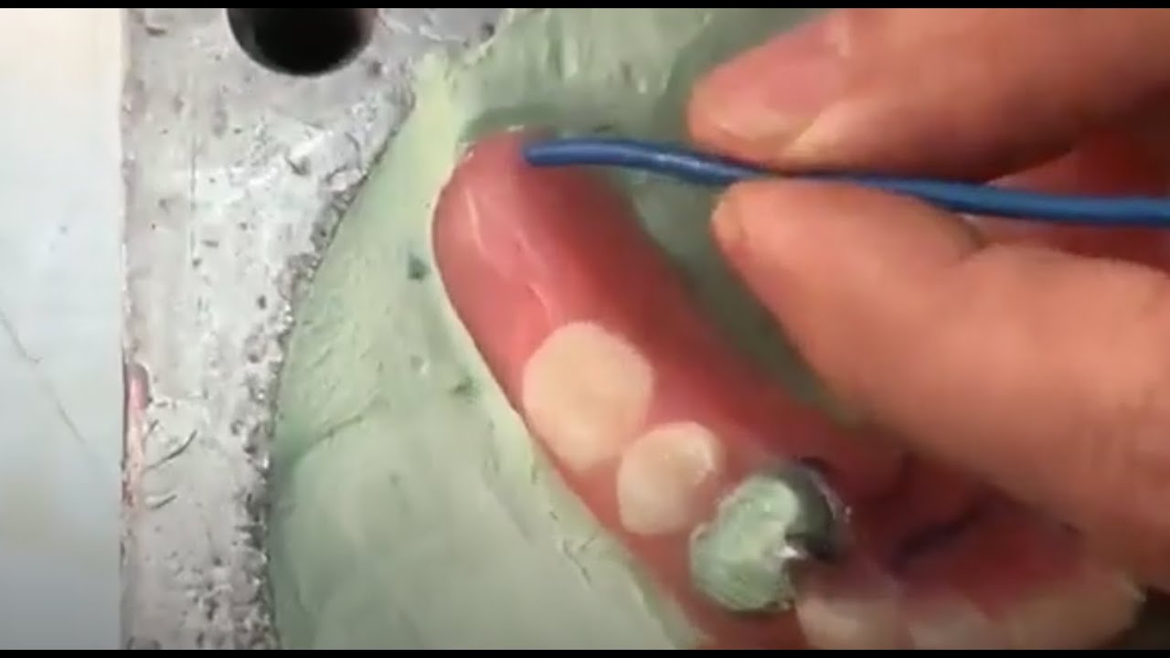 Tips Partial Flex® Líder en prótesis flexibles.