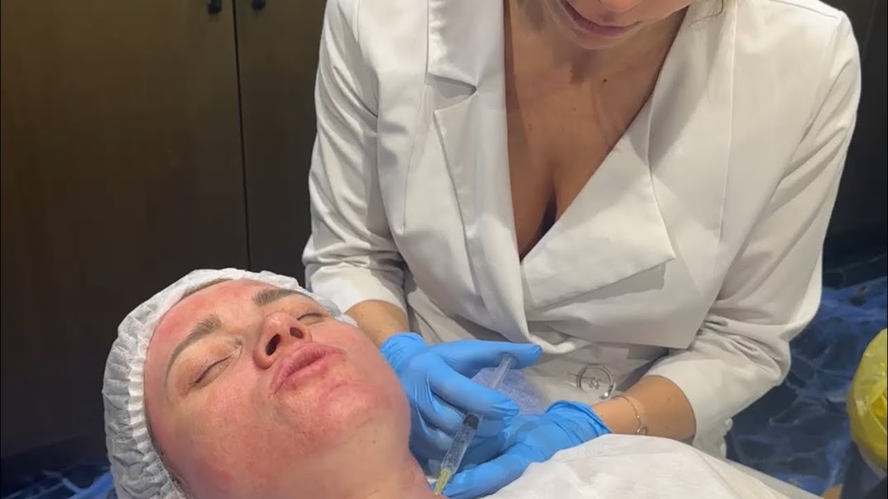 Лечение розацеа, Купероз, поддерживающая терапия. Запись эфира 28 января 2026