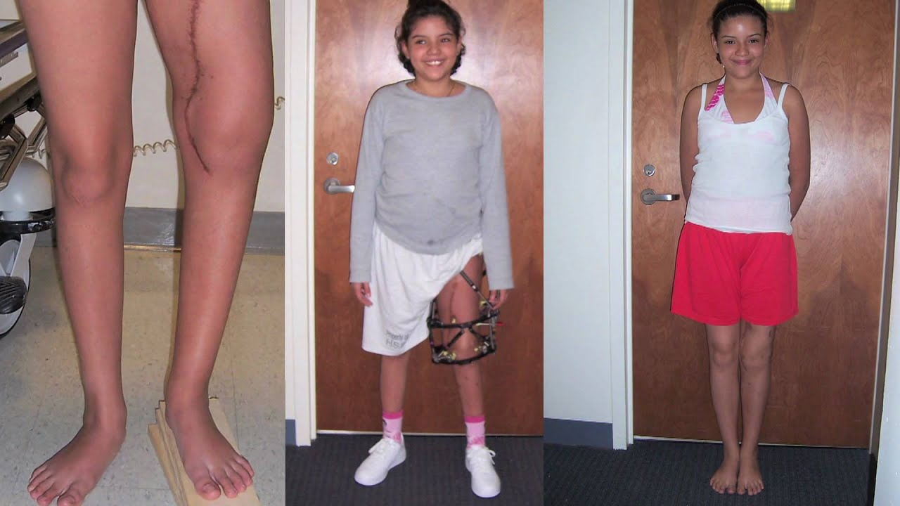 LIMB LENGTHENING DOCUMENTARY:  DR. ROZBRUCH and DR. FRAGOMEN