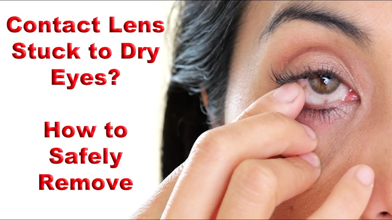 How to Safely Remove Stuck Contact Lens Dried to the Eye