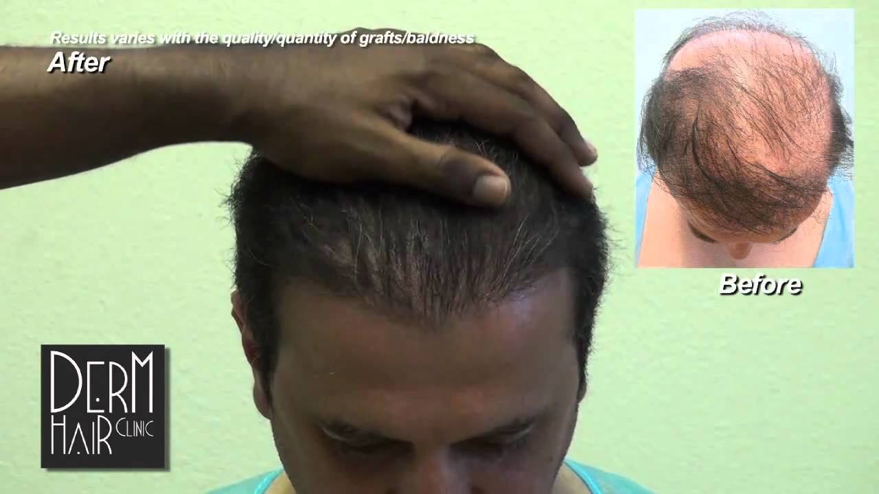 Body hair transplant, Hairpiece Problems, toupee problems  - A permanent solution