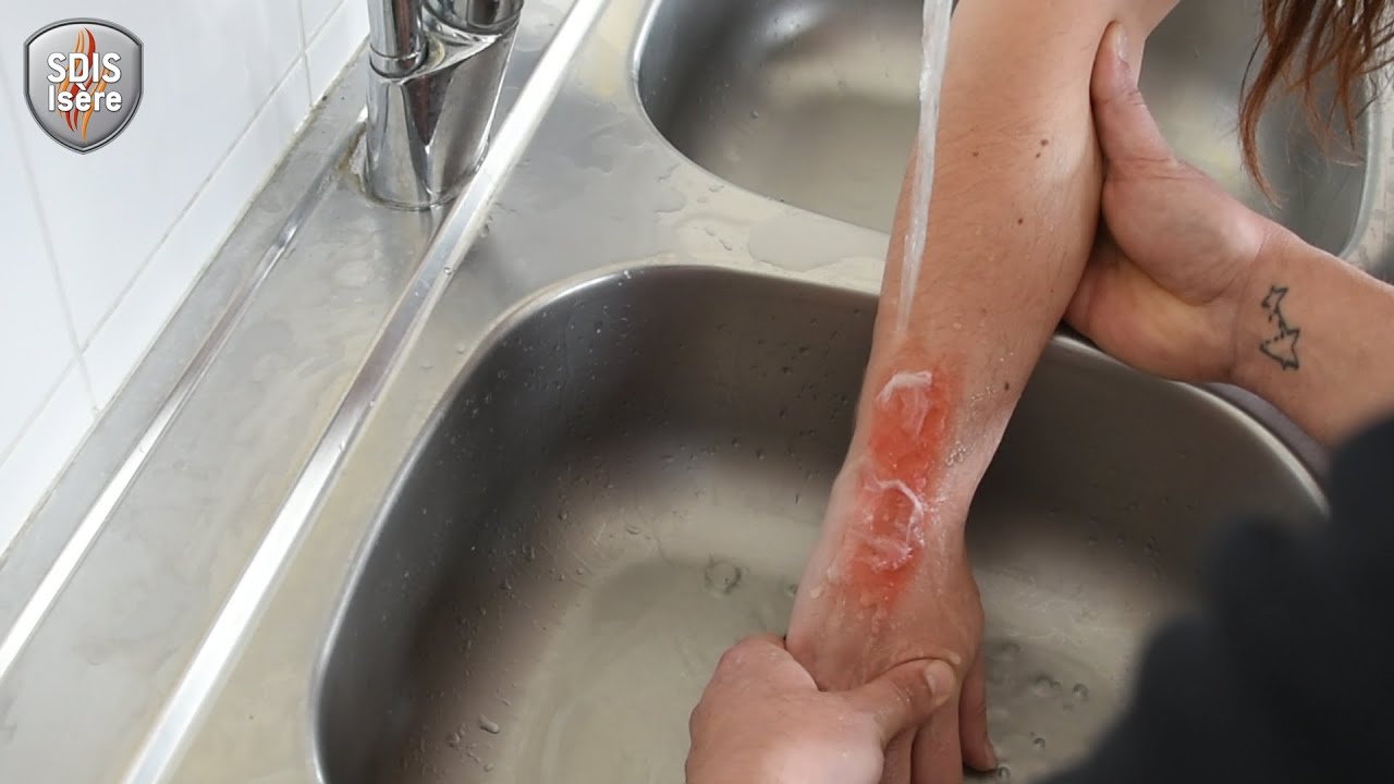Comment r&eacute;agir en cas de br&ucirc;lure thermique ?