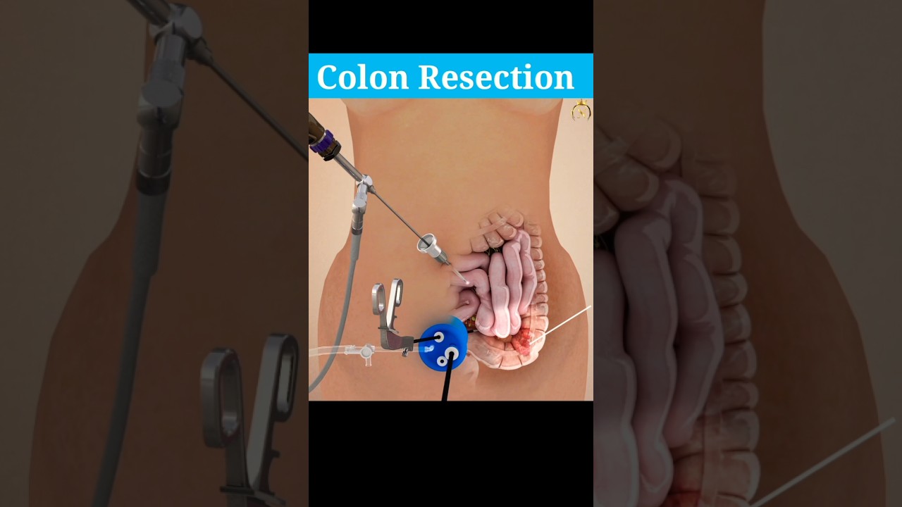 Colon Resection procedure -3D animation | #shorts #medical #laproscopicsurgery