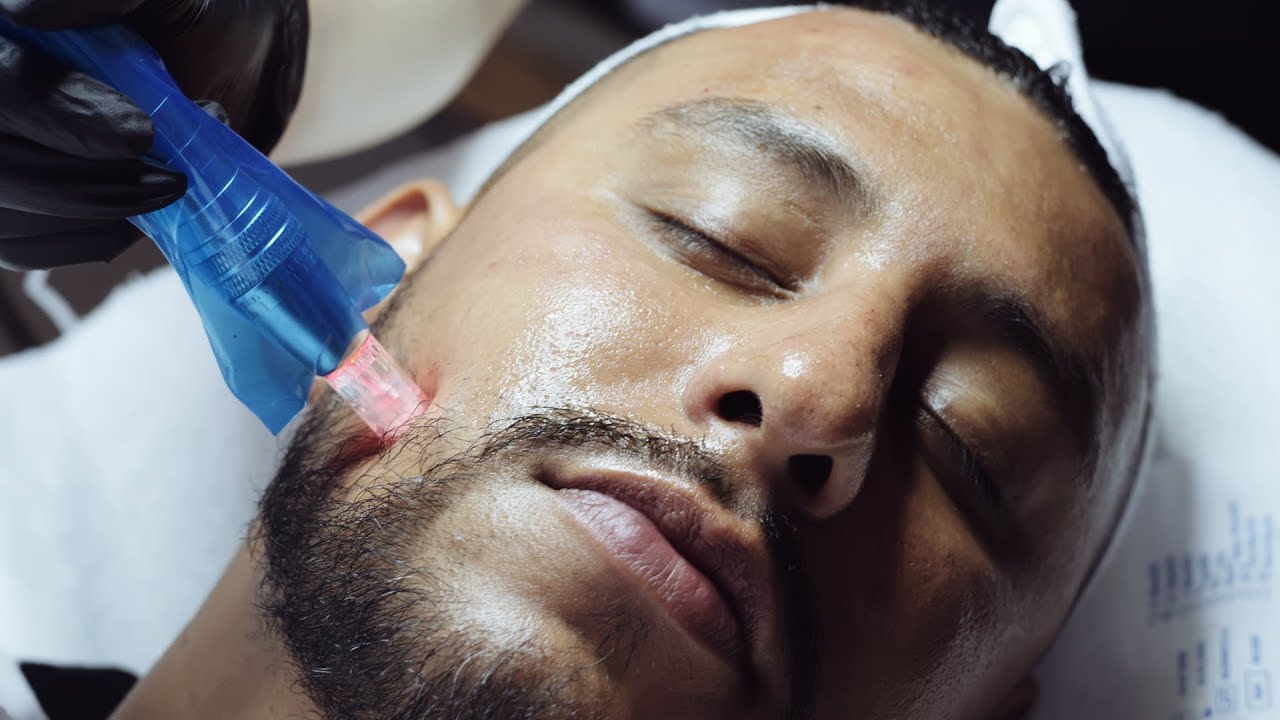 CIT-Microneedling Treatment | Dallas Skin Care Specialists | Jewel Skin Studio