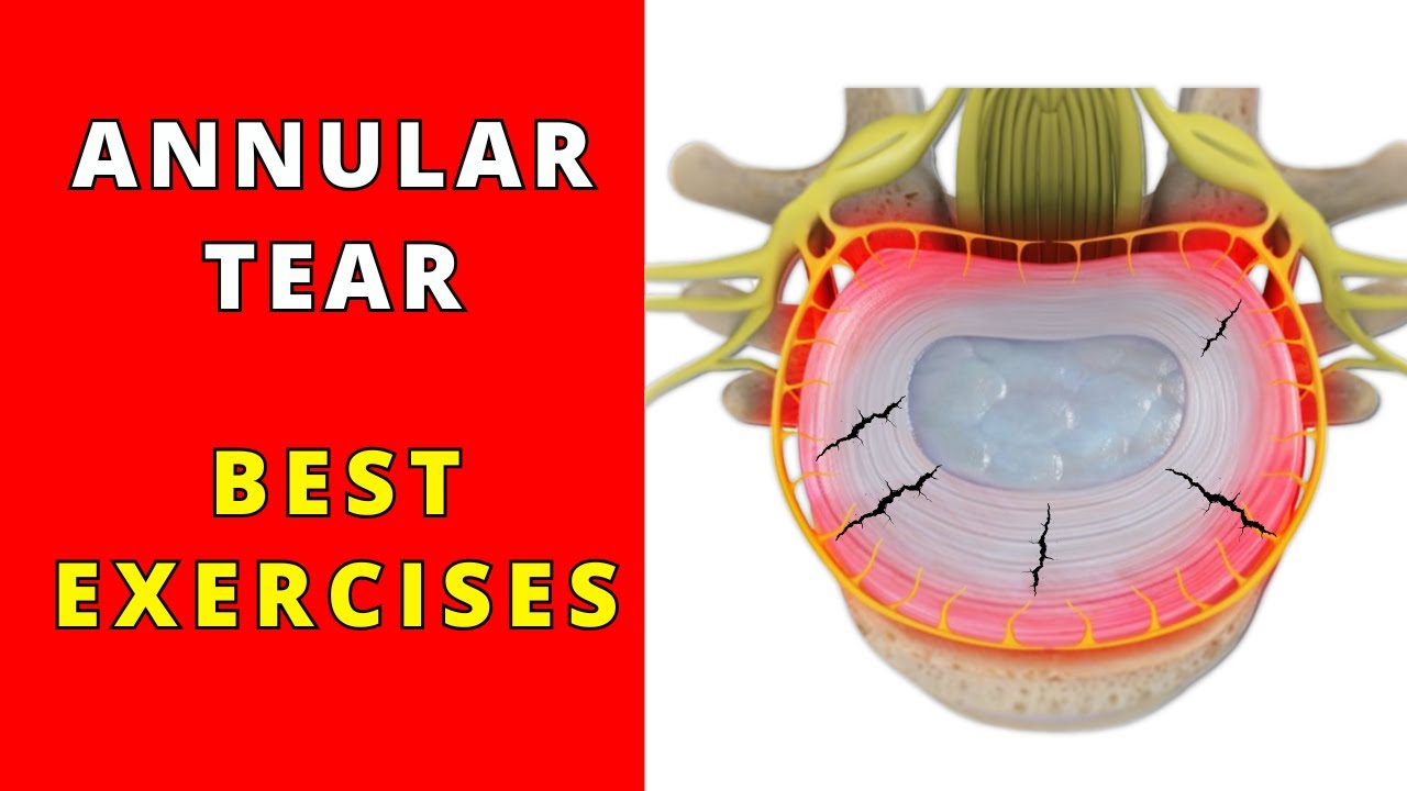 What is Annular Tear? What is the best exercise to maximise your healing and reduce your pain
