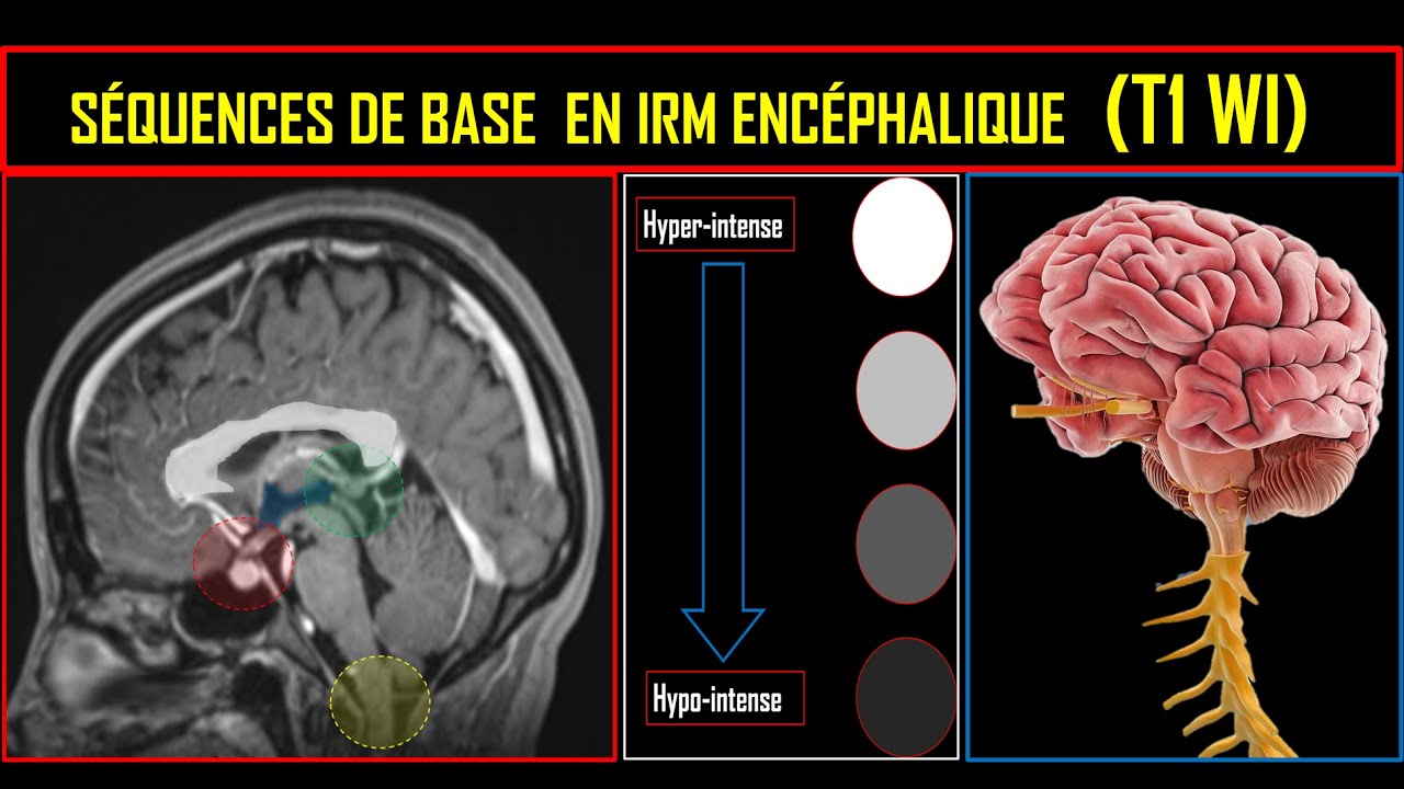 Séquences de base en IRM encéphalique (Séquence T1)