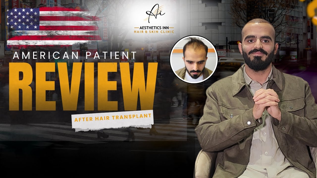 Extreme Baldness (Stage 7) Hair Transplant | USA Patient Experience #hairtransformation #review