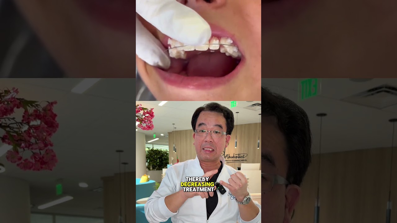 LightForce braces or regular? 😬 #orthodontist #lightforcebraces #braces #orthotips