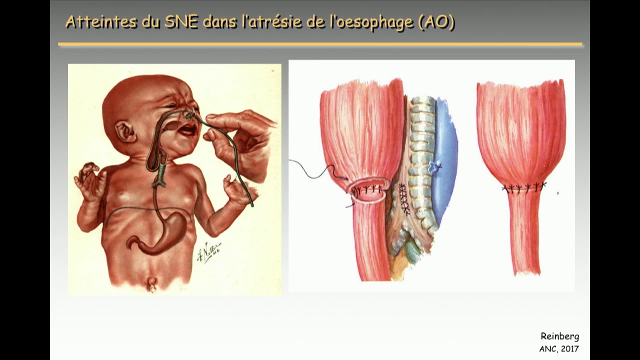 Chirurgie et dysmotilités oesophagiennes