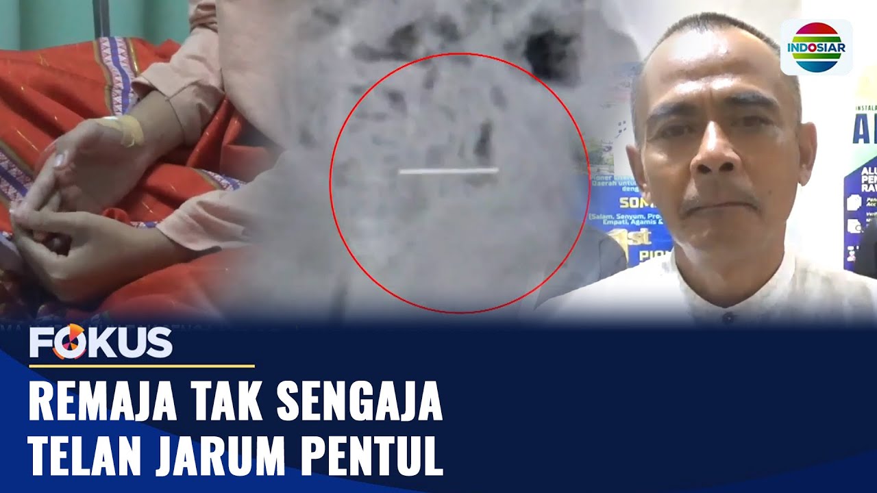 Jarum Pentul Tertelan Saat Remaja 13 Tahun Hendak Pasang Hijab | Fokus