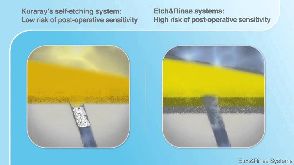 Self-etch vs etch & rinse