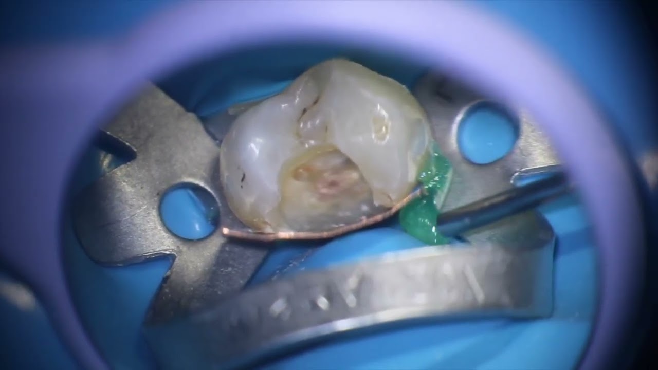 Restauração pré-endodontia