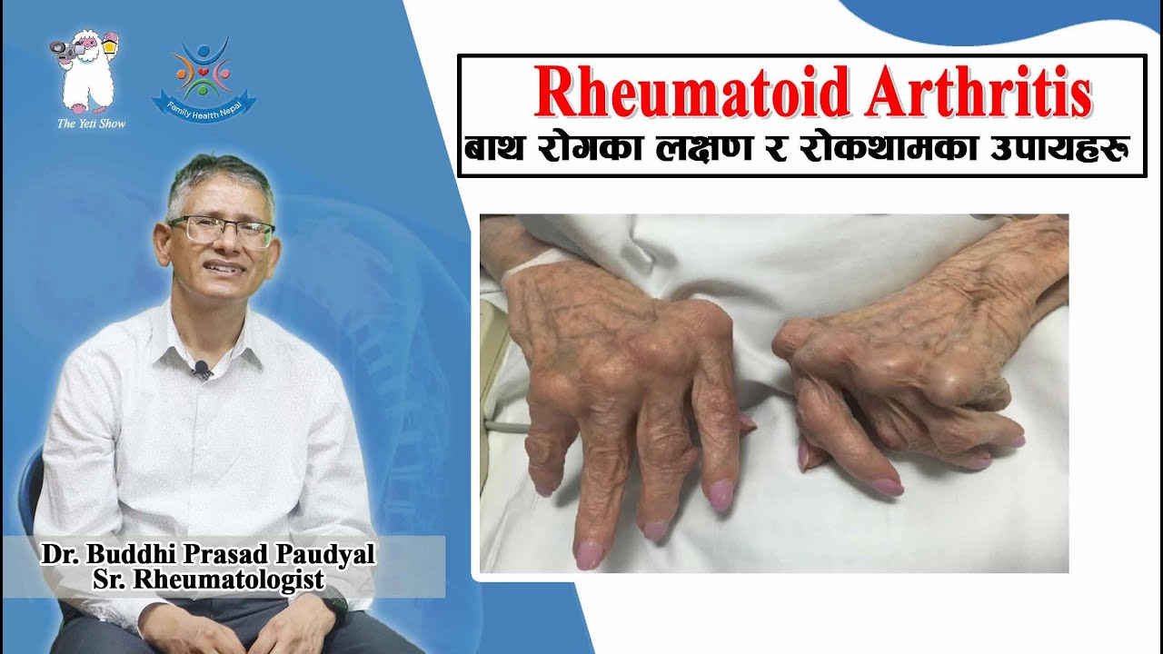 Rheumatoid Arthritis (बाथ रोगका लक्षण र   रोकथामका उपायहरु) Dr. Buddhi Paudyal