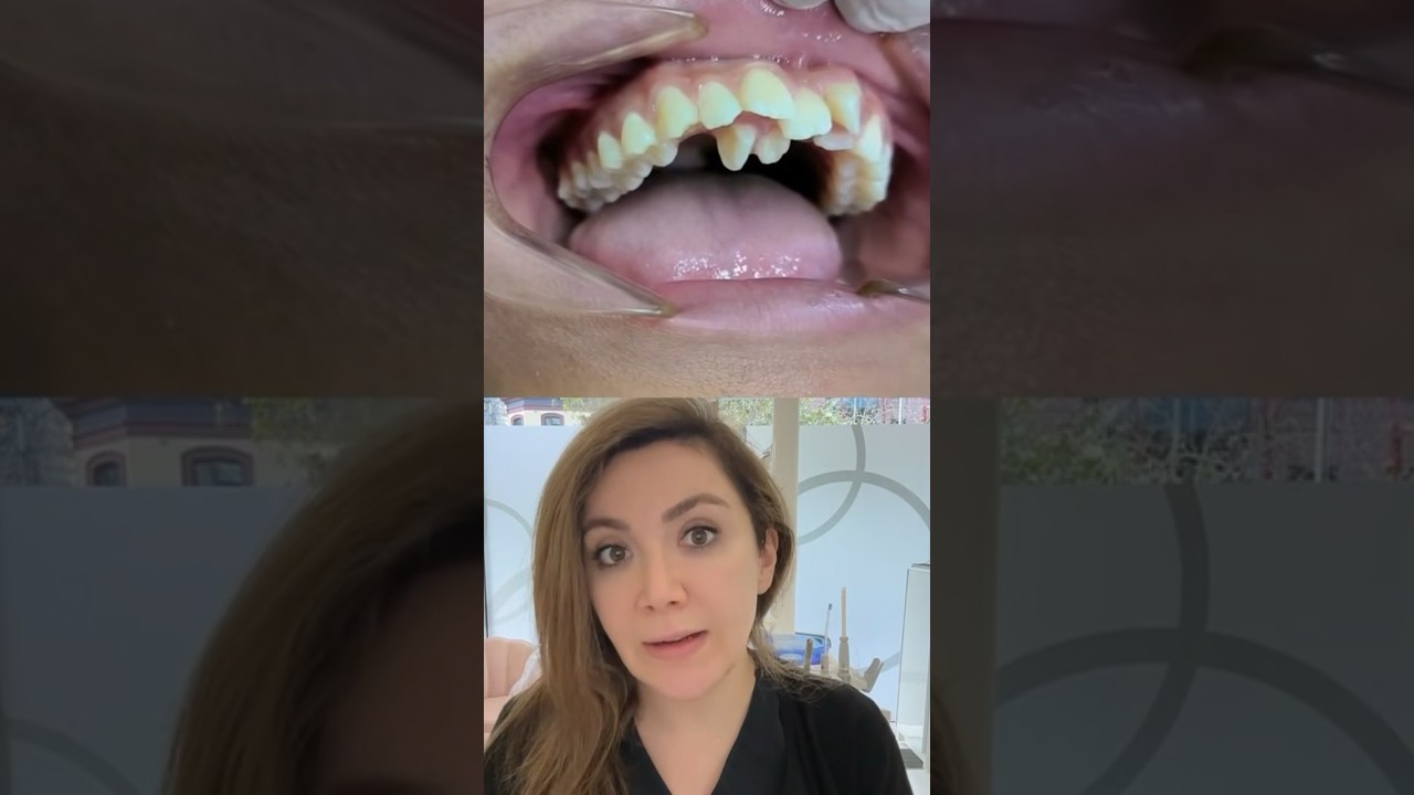 Сверхкомплектные или необычные зубы?!