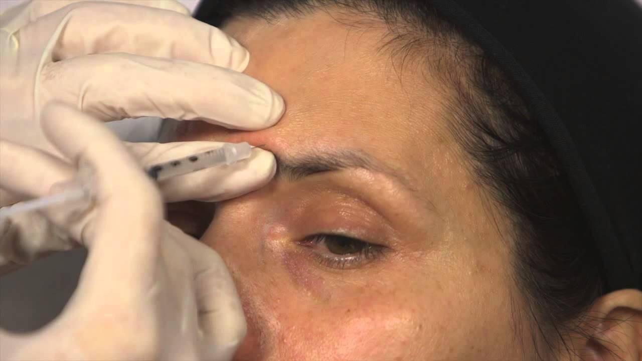 Behandlung mit Botox® - Faltenbehandlung Zornesfalten und Lachfalten - Dr. Patricia Ogilvie
