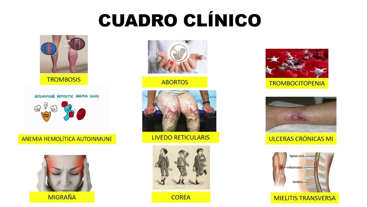 SÍNDROME ANTIFOSFOLIPÍDICO (SAF): DIAGNÓSTICO Y TRATAMIENTO