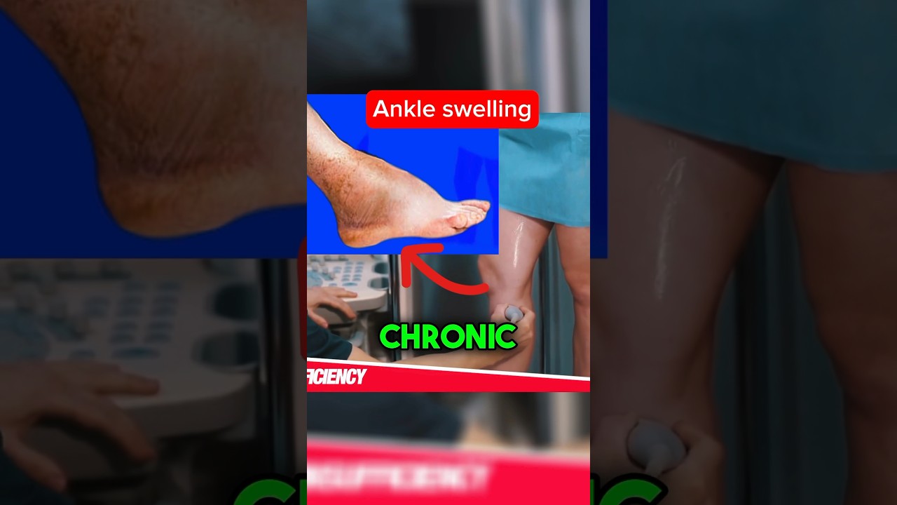 Chronic Venous Insufficiency
