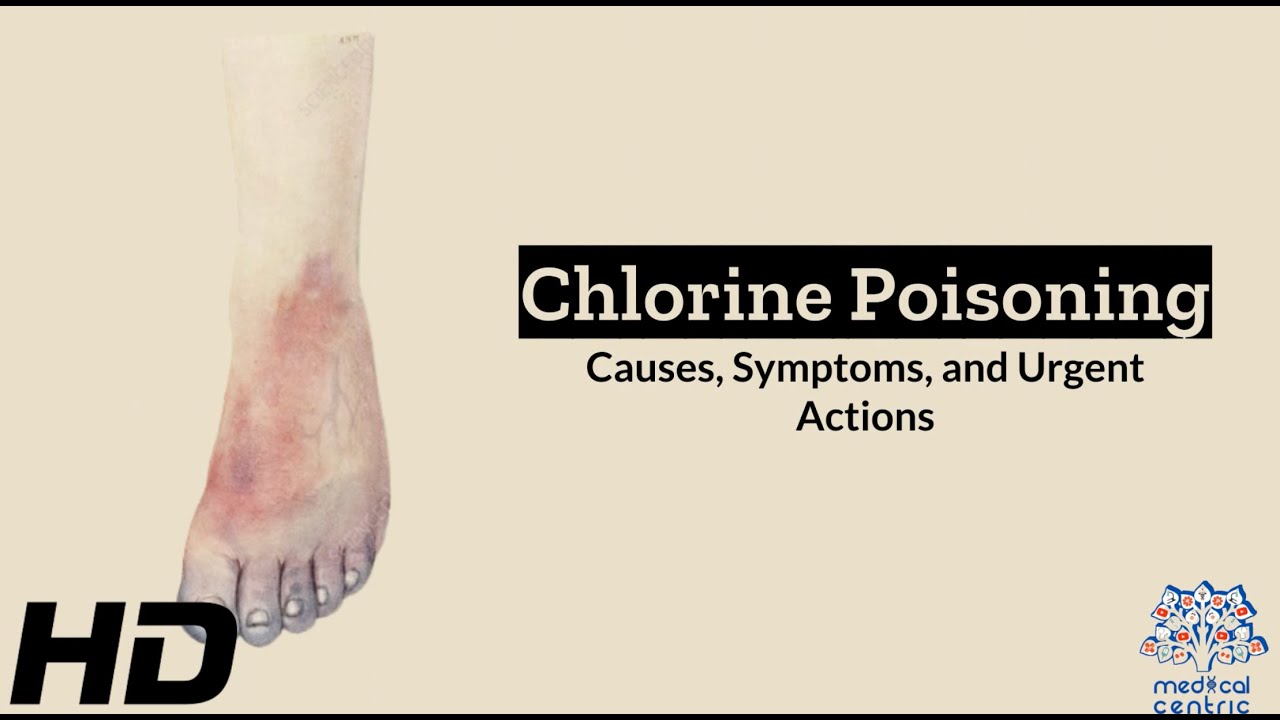 Chlorine Poisoning: Signs and Life-Saving Measures