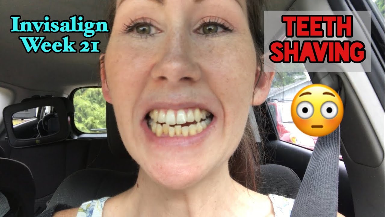 Invisalign week 21 update / getting teeth shaved